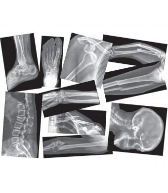 Roylco Broken Bones X-Ray Set