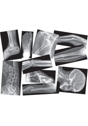 Roylco Broken Bones X-Ray Set
